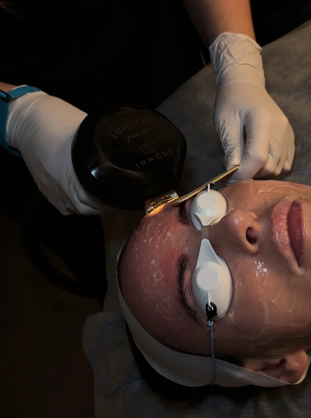 Lumecca IPL Peak treatment at FACE Weybridge
