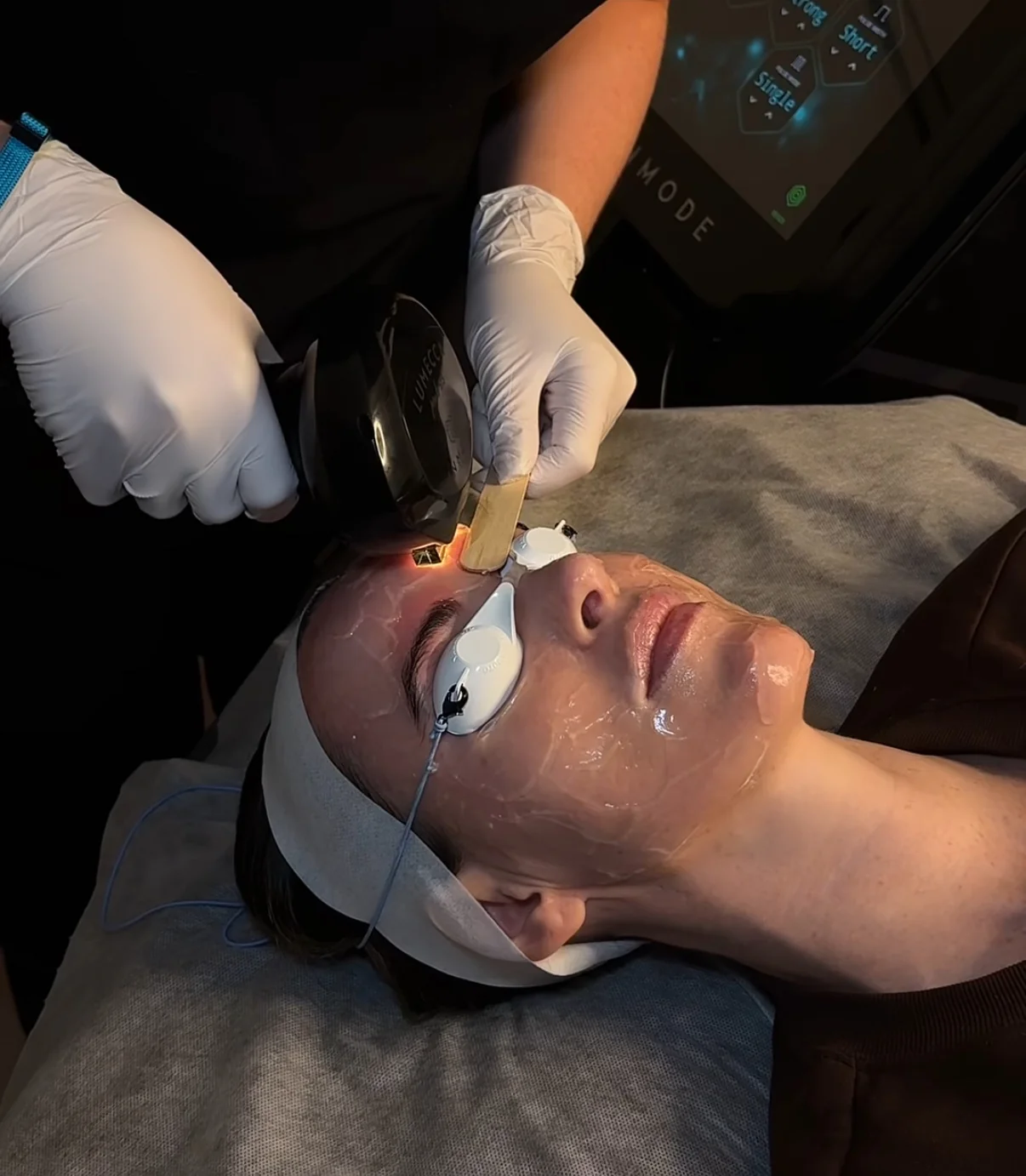 Pigmentation treatment at FACE Weybridge